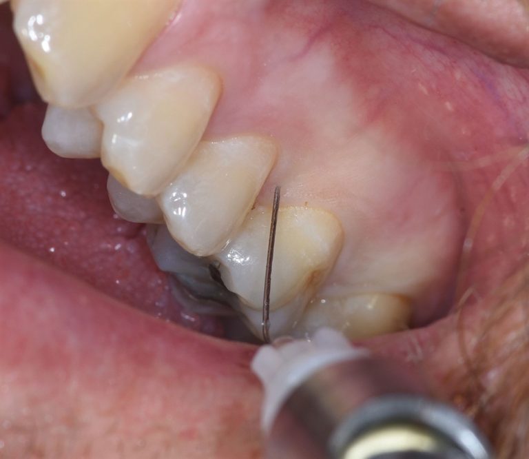 Injection technique tips for palatal anesthesia Southwest Family