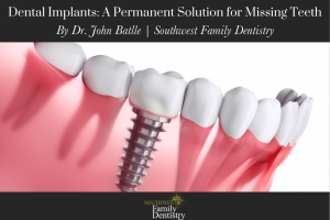 Dental Implants A Permanent Solution for Missing Teeth