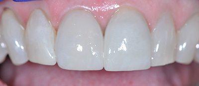 PATIENT AFTER TREATMENT
