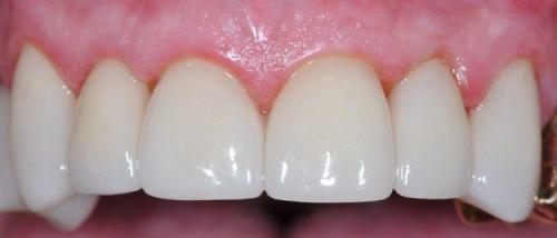 MALE PATIENT AFTER SIX ALL-CERAMIC CROWNS