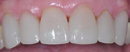 FEMALE PATIENT AFTER SIX ALL-CERAMIC CROWNS