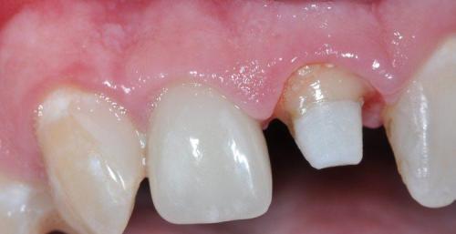 PATIENT MISSING CROWN FROM FRONT TOOTH