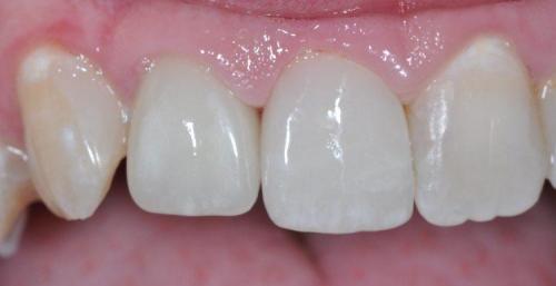 FRONT TOOTH RESTORED WITH ALL-CERAMIC CROWN