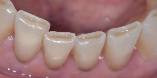 PATIENT BEFORE TREATMENTFront teeth restored with resins.
