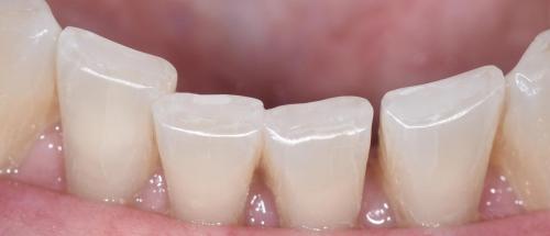 PATIENT AFTER TREATMENTNo local anesthetic needed!