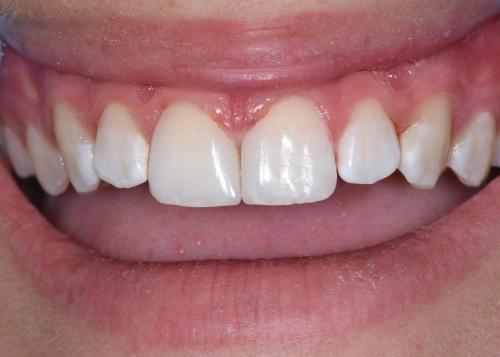 PATIENT AFTER TREATMENT