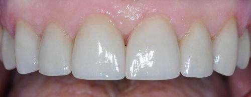 EMAX ALL CERAMIC CROWNS