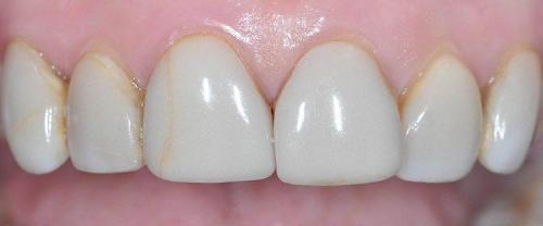 DISCOLORED RESIN VENEERS
