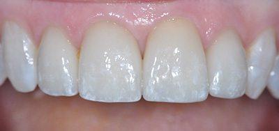 PATIENT AFTER TREATMENT