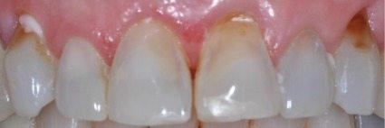 PATIENT BEFORE TREATMENT