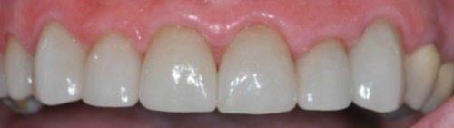 PATIENT AFTER TREATMENT