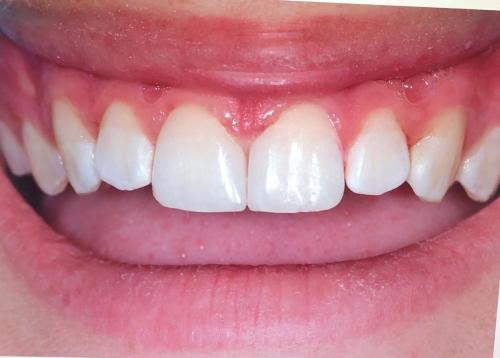 PATIENT AFTER TREATMENT